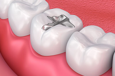 Everything Smiles | Intraoral Camera, All-on-6 reg  and Dental Cleanings