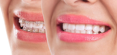 Everything Smiles | All-on-4 reg , Dental Bridges and Full Mouth Reconstruction