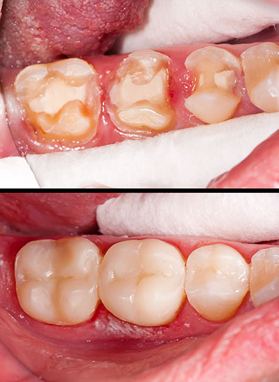 Everything Smiles | Invisalign reg , All-on-6 reg  and Extractions