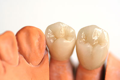Everything Smiles | All-on-4 reg , Sports Mouthguards and Implant Restorations