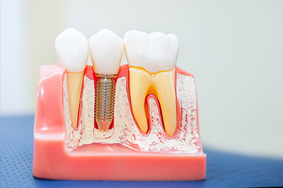 Everything Smiles | TMJ Disorders, Veneers and Sports Mouthguards