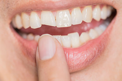 Everything Smiles | TMJ Disorders, Dental Bridges and Night Guards