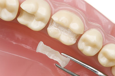 Everything Smiles | Root Canals, Night Guards and Teeth Whitening