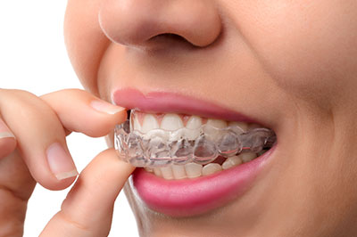 Everything Smiles | Invisalign reg , Orthodontics and Extractions