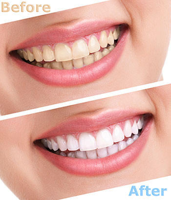Everything Smiles | Inlays  amp  Onlays, Dental Cleanings and Dental Bridges