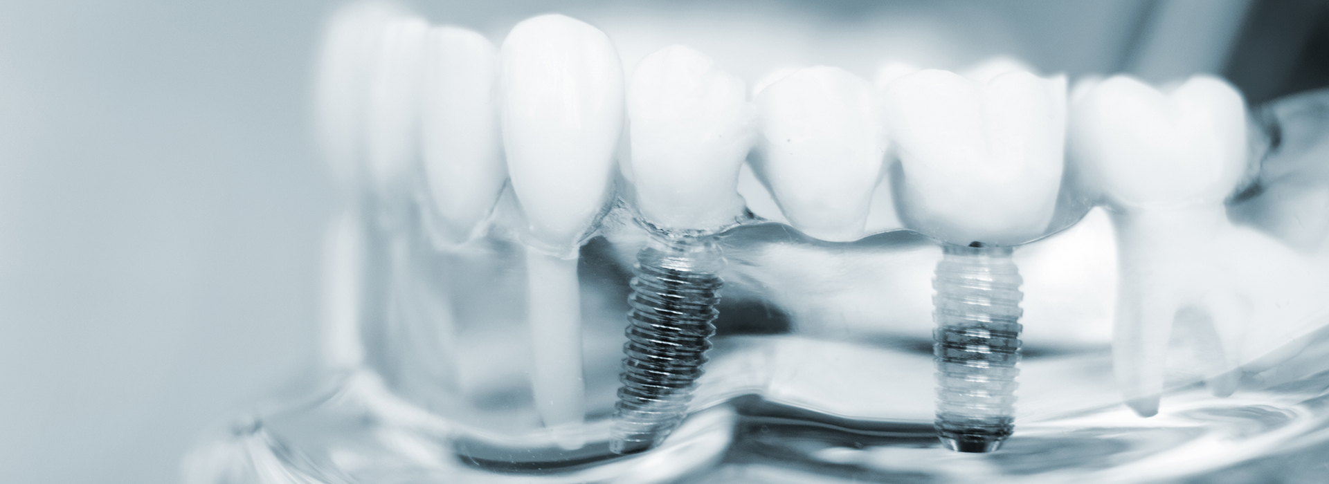 Everything Smiles | Ceramic Crowns, Crowns and Fluoride Treatment