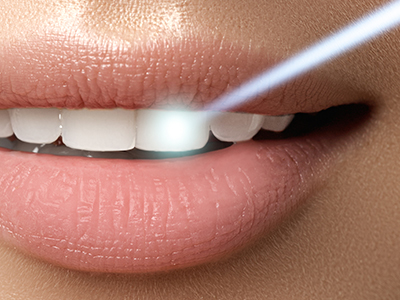Everything Smiles | Oral Cancer Screening, Extractions and All-on-4 reg 