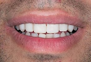 Everything Smiles | Fluoride Treatment, Full Mouth Reconstruction and TMJ Disorders