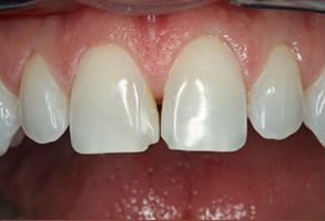 Everything Smiles | Orthodontics, Dental Bridges and Fluoride Treatment